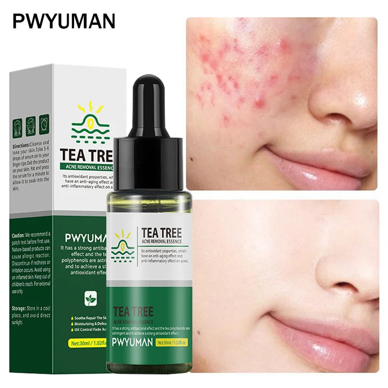 Clear skin tea tree serum, acne removal, repair acne, shrink pores, remove blackheads, and perform facial cleaning.